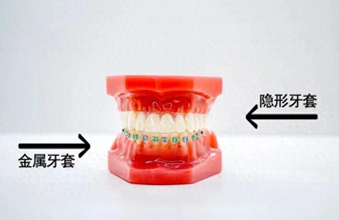 丹东牙齿矫正 隐形牙套和金属牙套应该怎么选？(图1)