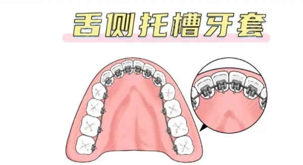 更新2024牙齿矫正多少钱价格表金属隐形舌侧矫正收费降价啦(图5)